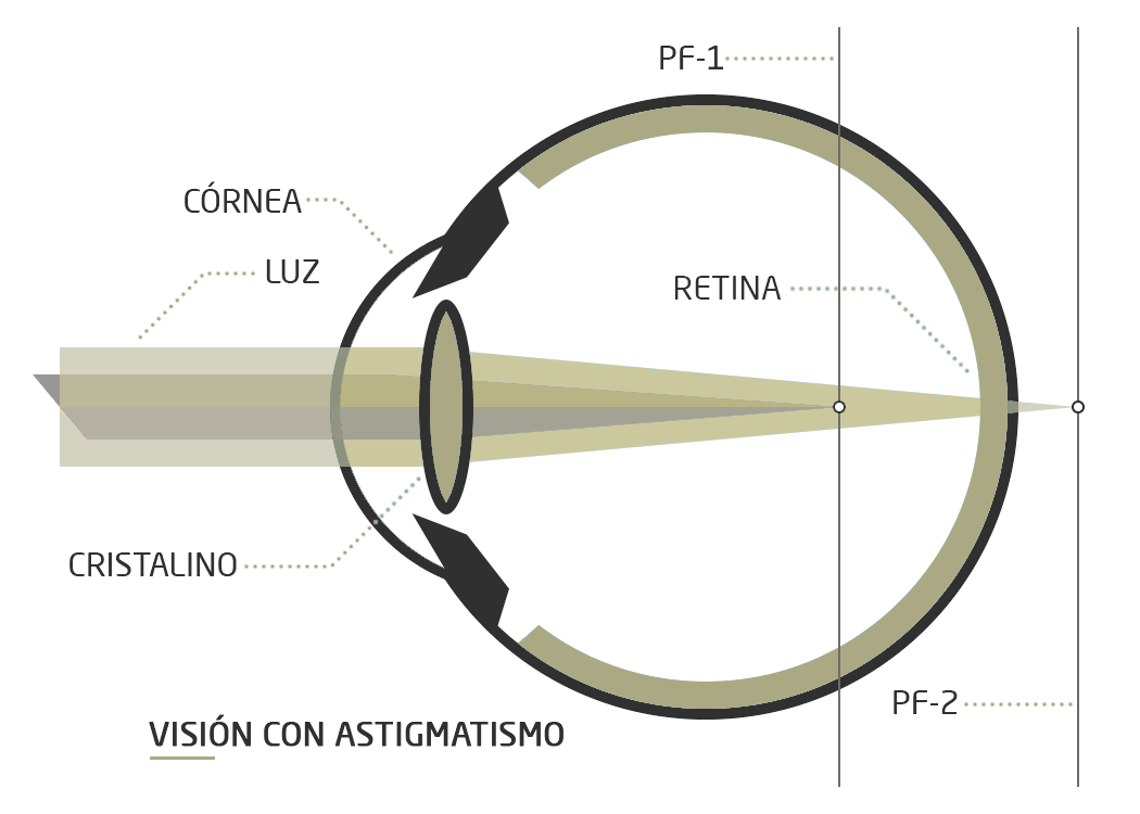 astigmatismo tratamiento cirugia refractiva clinica rahhal valencia astigmatismo tratamiento cirugia