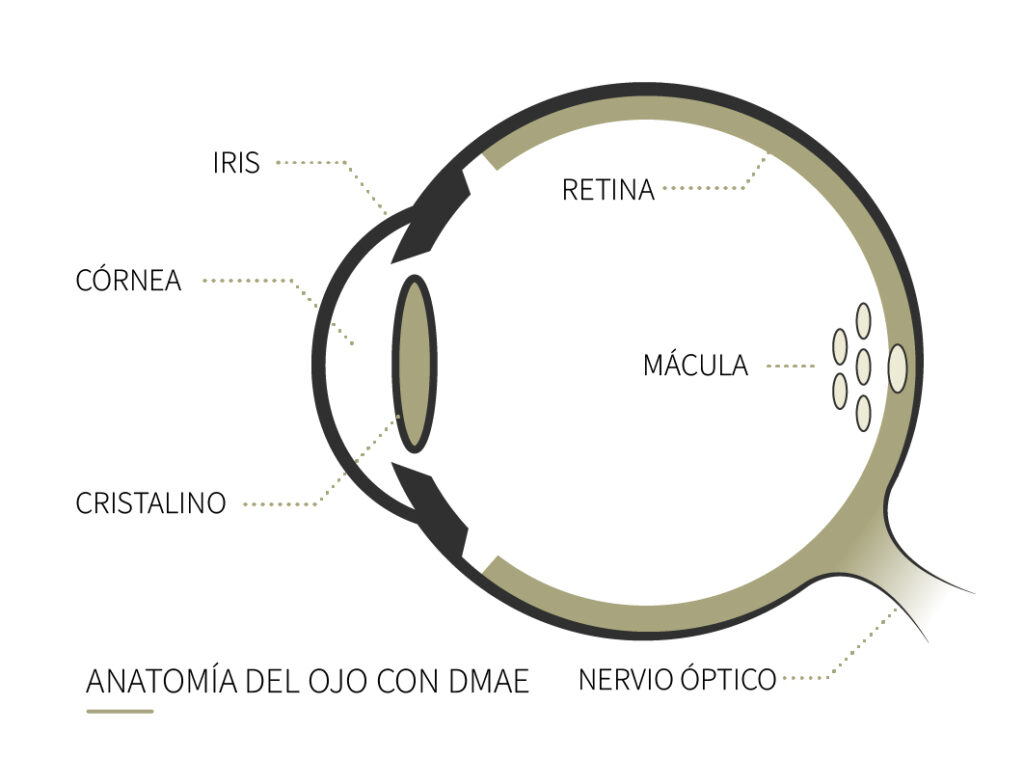 Qué es la DMAE o degeneración macular asociada a la edad Clínica Rahhal