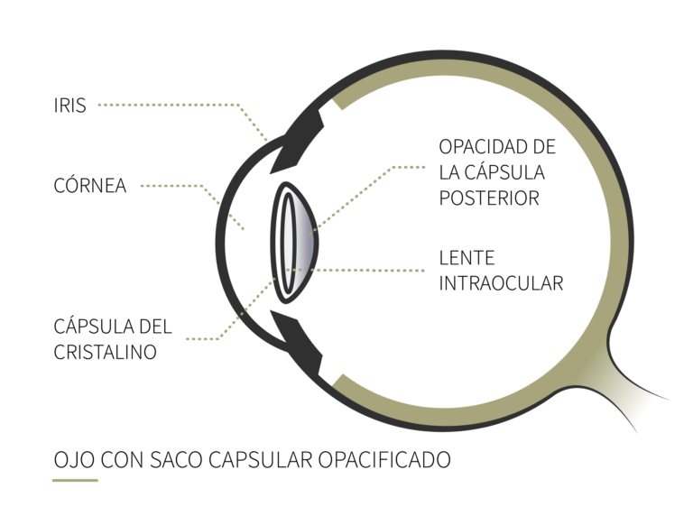 Qu Es La Capsulotom a Con L ser YAG Cl nica Rahhal qu-es-la-capsulotom-a-con-l-ser-yag-cl-nica-rahhal