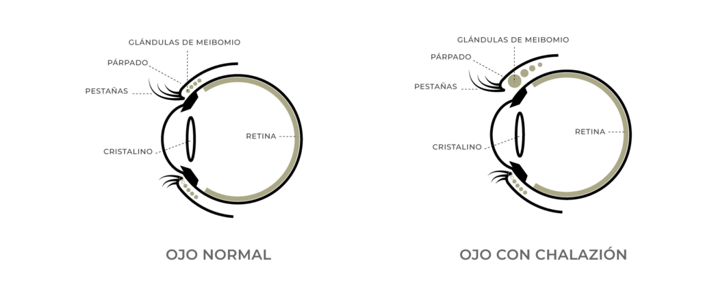 Diferencias entre orzuelo y chalazión: causas, tratamientos y prevención